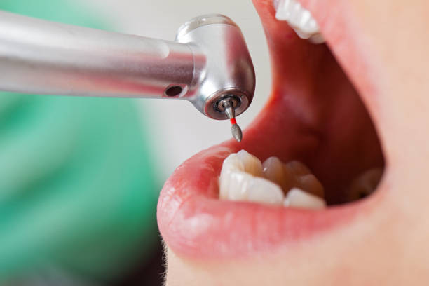 Best Emergency Treatment for Dental Infections or Abscesses in Glandorf, OH